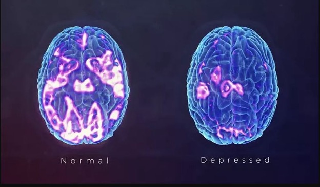 Normal vs Depressed brain